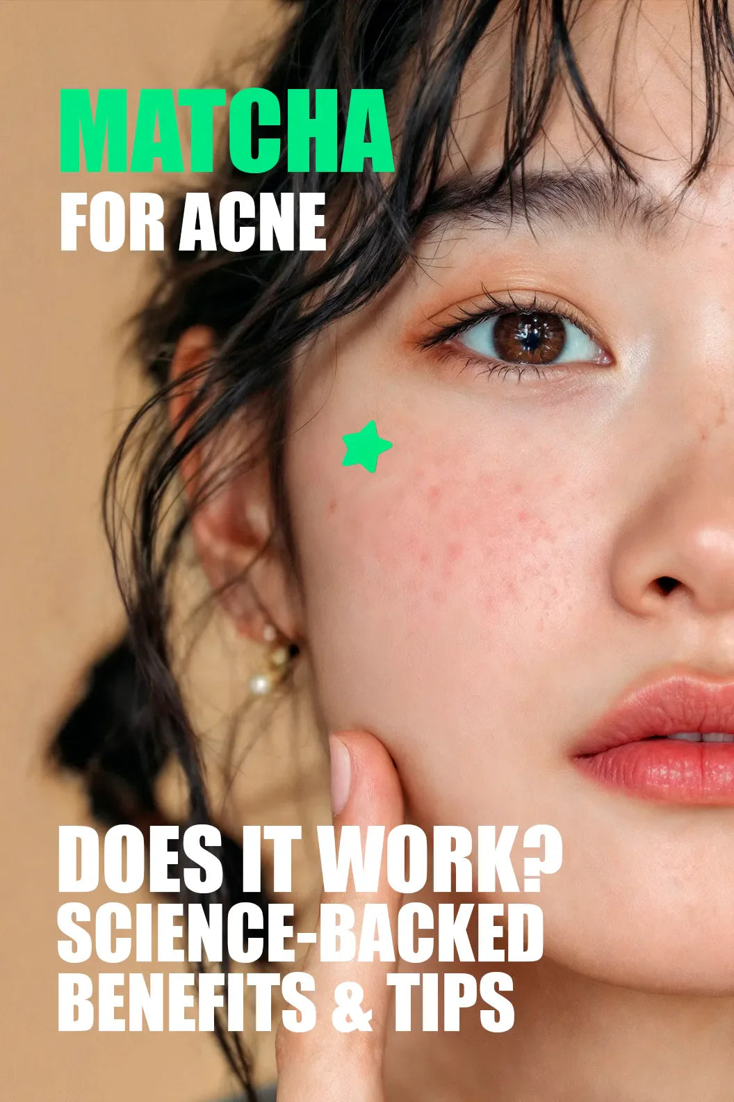 Woman’s face with acne marks, featuring text: 'MATCHA FOR ACNE – DOES IT WORK? SCIENCE-BACKED BENEFITS & TIPS